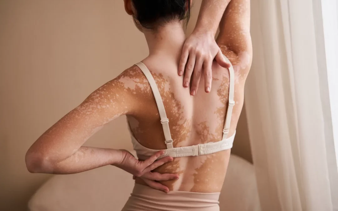 Vitiligo im Überblick: Erscheinungsformen, Symptome und mehr