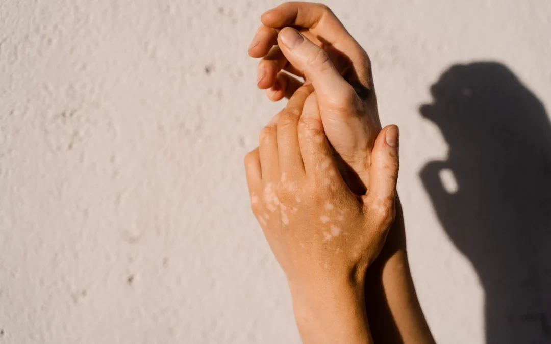 Vitiligo erklärt: Definition, Ursachen und Prävalenz